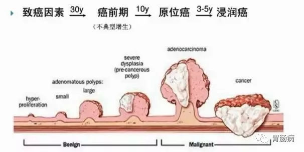 體檢查出腸息肉一定要切除！ 95%腸癌由它演變而來(lái)