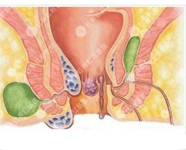 南寧哪個(gè)醫(yī)院可以做肛周膿腫？